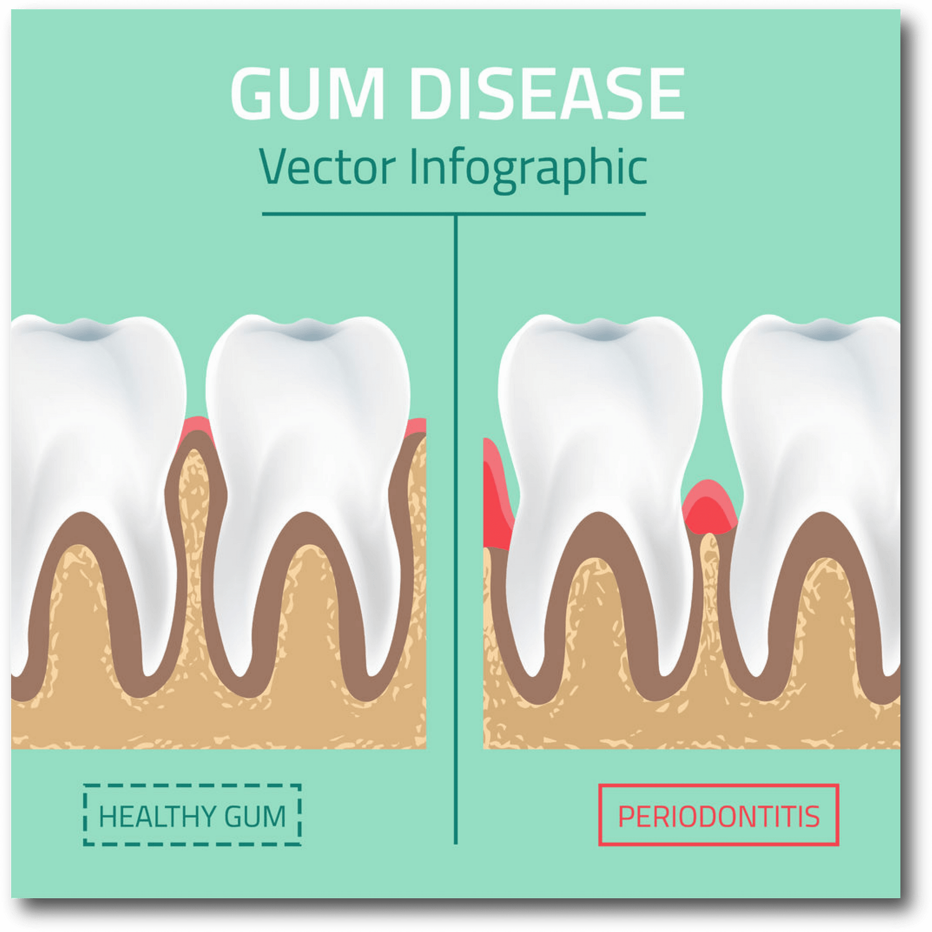 Periodontal Disease LORD FAMILY DENTISTRY